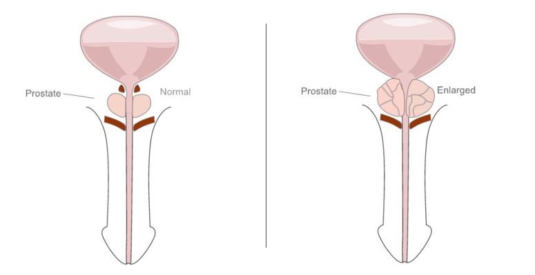 Enlarged prostate